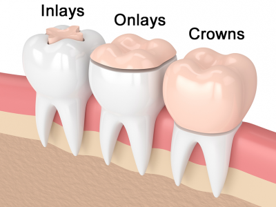 02-02-2019_11-04-03_inlays-and-onlays-treatment-in-coimbatore